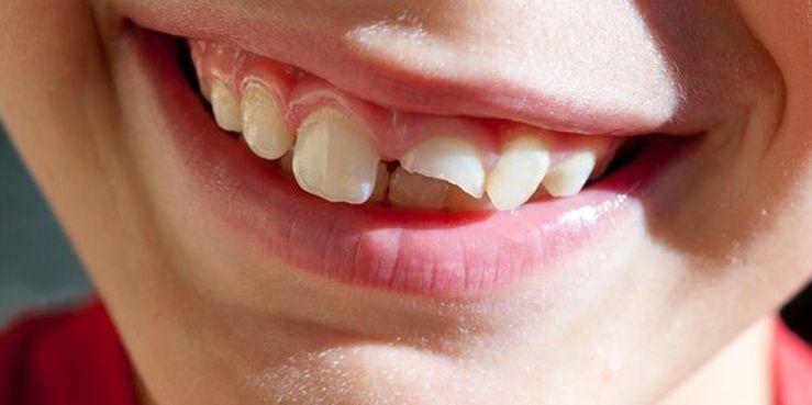 Oral Health After a Broken Tooth: Tips for Proper Care and Maintenance